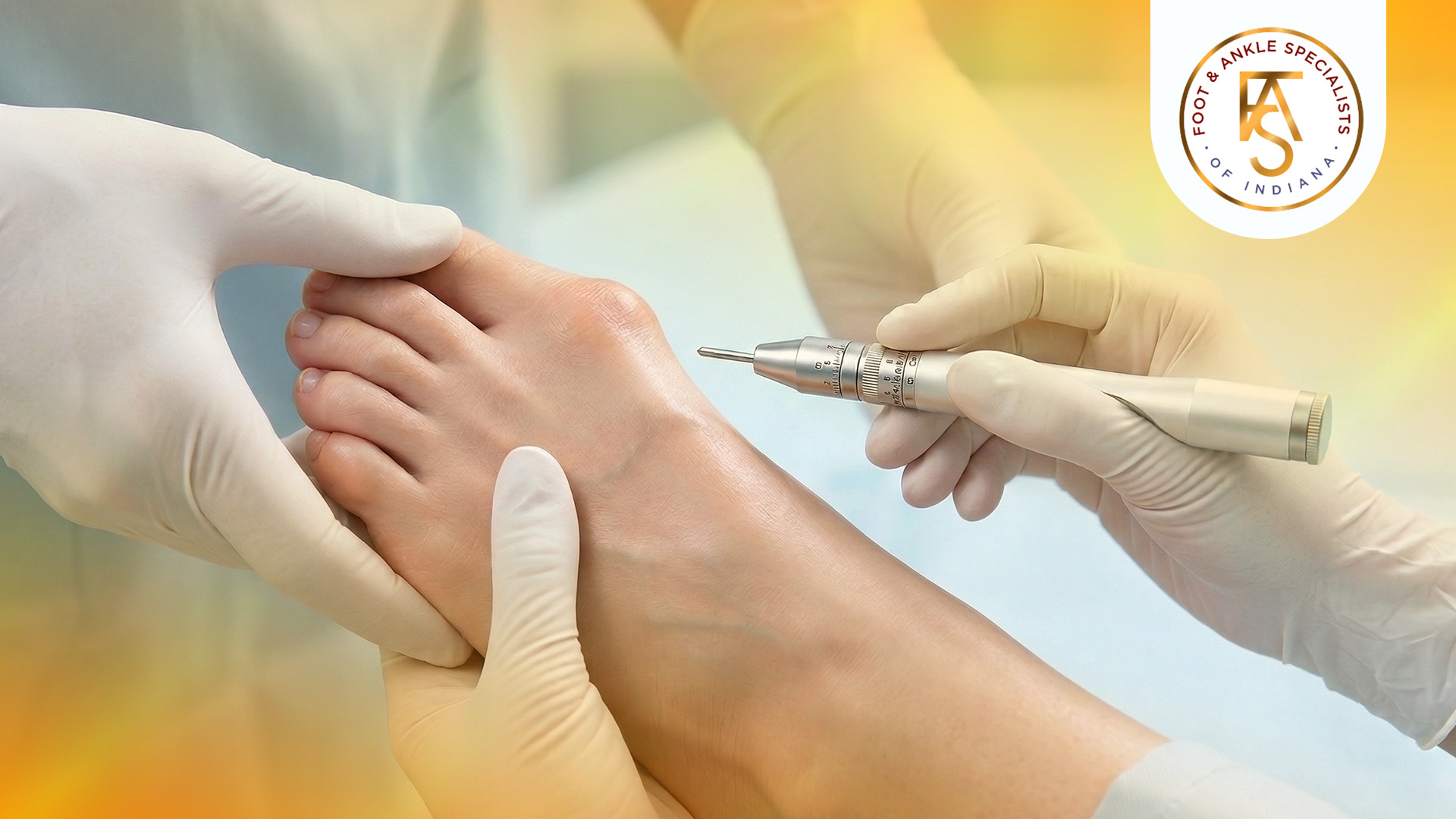 Say goodbye to bunion pain: everything you need to know about bunion surgery surgery