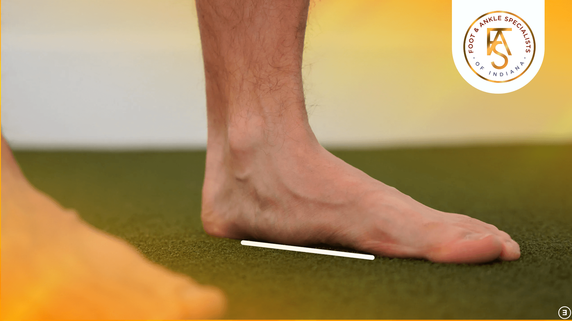 Flat Feet Treatment: Causes, Symptoms & When to Consider Surgery